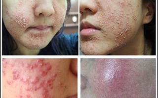 Kinh hoàng với mỹ phẩm làm trắng da cấp tốc