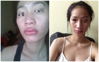 Hà Nội: Hàng loạt nạn nhân tố spa tiêm chất làm đầy dởm khiến mũi lệch, môi sưng