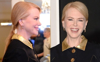 "Thiên nga Úc" - Nicole Kidman lộ khuôn mặt bị biến dạng vì botox