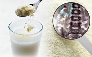 Con bị hoại tử ruột, sỏi thận do cách pha sữa sai mà tưởng đúng của cha mẹ 