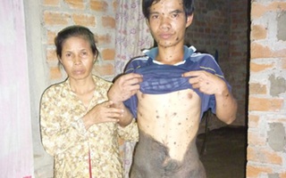 Chàng trai với “lớp da trâu”