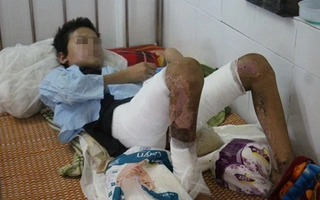 Bé trai bị đẩy vào đống lửa: 2 bên đùi gần như bị cháy hoàn toàn