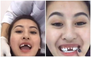 Tự livestream cảnh làm răng, Hà Lade khiến dân tình choáng nặng vì hai răng cửa mài bé tí