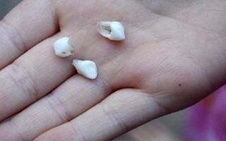 Mơ thấy gãy răng liệu có phải là điềm gở như mọi người vẫn nghĩ?
