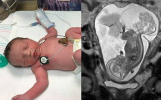 Lấy ra rồi đưa lại vào bụng mẹ khi mới 23 tuần, bé gái được sinh ra lần thứ 2 ở tuần thai 36 như 1 phép màu