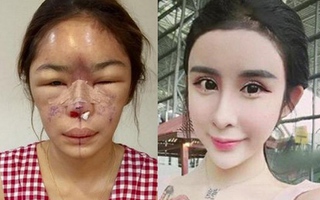 Ngược đời "thiên nga hóa vịt" vì nghiện phẫu thuật thẩm mỹ 