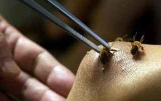 Nọc độc chết người từ vết ong đốt và những điều ai cũng phải biết