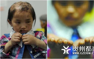 Bố dội nước sôi lên đầu, khâu miệng con gái