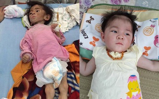 Yêu thương chính là điều kỳ diệu giúp bé gái 14 tháng nặng 3,5kg thay da đổi thịt như thế này!