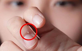 Đừng coi thường mẩu da thừa này, chúng đã khiến bé gái 7 tuổi phải nhập viện vì thói quen hầu như ai cũng mắc phải