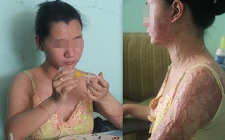 Những người phụ nữ vô tội bị hủy hoại dung nhan, mất đi tương lai và ám ảnh suốt đời vì axit