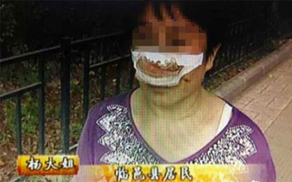 Trung Quốc: Cắn đứt mũi vợ vì không chịu trả lời điện thoại