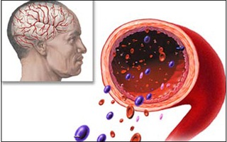 Hội chứng serotonin do thuốc