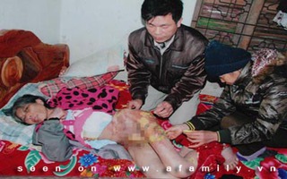 Hãi hùng những vết thương lở loét trên người osin bị chủ hành hạ
