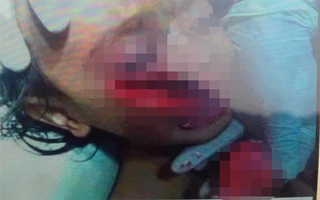 “Ngã ngửa” sự thật thông tin về em bé mồ côi cha mẹ, ngã vào lưỡi cuốc bị thương nghiêm trọng