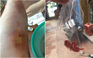 Vụ “quên” bông trong vết thương: Đình chỉ bác sĩ phẫu thuật