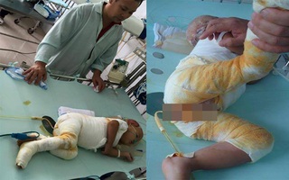 Mẹ bất cẩn để con ngã ngồi vào nồi canh nóng 25 lít