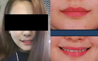 PTTM miệng cười... cánh cung - Trào lưu làm đẹp lạ lùng xứ Hàn