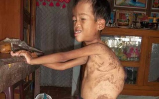 Bé gái mắc bệnh lạ với 2 nửa cơ thể khác nhau