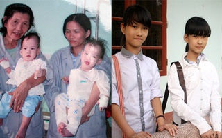 Những cặp song sinh dính liền được tách thành công: Ngày ấy - bây giờ