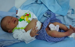 Bé sơ sinh bị kiến cắn toàn thân trong thùng mì tôm