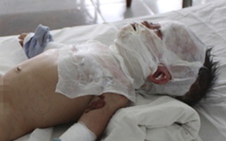 Mẹ đi “buôn chuyện”, con 8 tháng tuổi bị bỏng