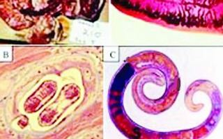 Biểu hiện khi mắc bệnh giun xoắn