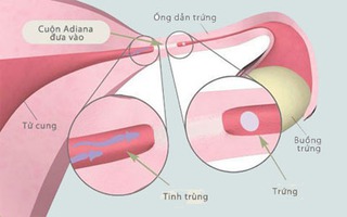 Thêm một hiểu lầm về nguyên nhân khó có thai ở phụ nữ