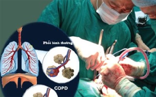 Ðột phá trong điều trị bệnh phổi tắc nghẽn mạn tính