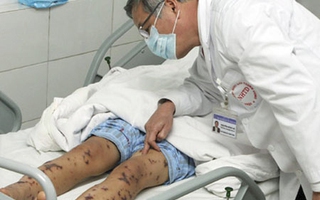 Tại sao nhiễm liên cầu lợn rất nguy hiểm