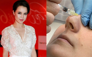 Mổ xẻ “thần dược” nâng mũi không cần phẫu thuật