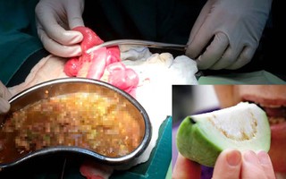 Nguy cơ mắc bệnh “tử vong nếu mổ chậm sau 6 giờ” từ thói quen ăn ổi của nhiều người