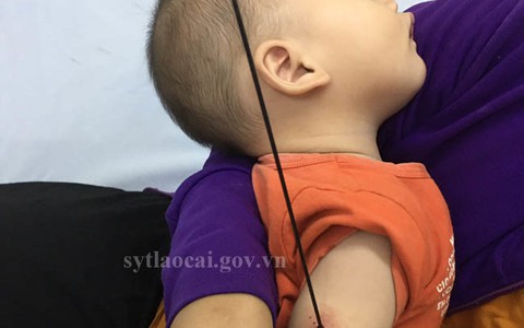 Nan ô đâm xuyên cánh tay bé 6 tháng tuổi