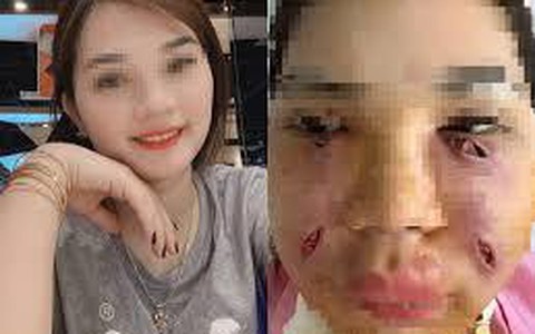 Tiêm mỡ tự thân làm đẹp, cô gái Hà Thành phải rạch mặt sưng nề để nặn ổ mủ