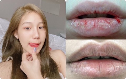 4 cây son dưỡng môi "phù phép" từ môi bong tróc, nứt nẻ đến thâm xám xịt thành mềm mại, căng mọng như ý