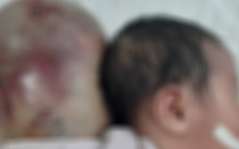 Bé sơ sinh mang khối thoát vị "khổng lồ" sau đầu