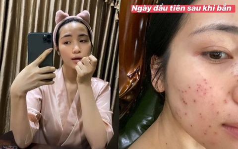 Hòa Minzy gây sốc khi để lộ gương mặt toàn nốt đỏ li ti, nhìn qua đã thấy rùng mình