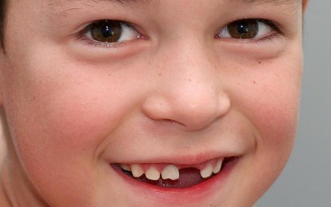 Gửi con đi nhà trẻ, khi đón về mẹ thấy con bị mất răng