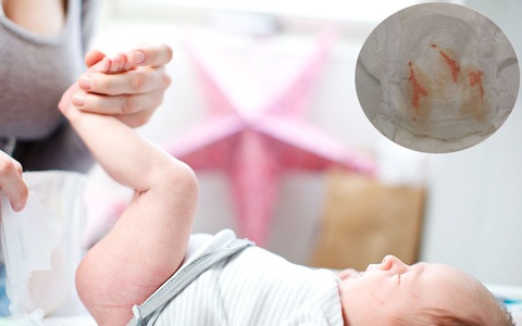 Thay bỉm cho con, mẹ phát hoảng khi thấy trong bỉm con có màu hồng như màu máu