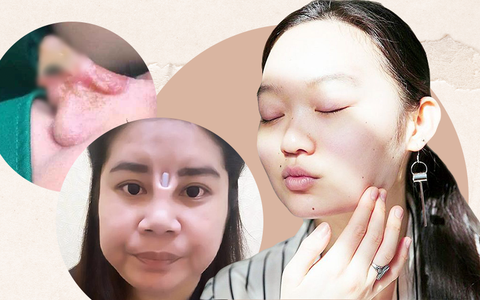 Hàng loạt biến chứng "đáng sợ" khi nâng mũi, nhìn thôi cũng thấy đau rụng rời: Chị em muốn can thiệp dao kéo cần rút kinh nghiệm ngay!