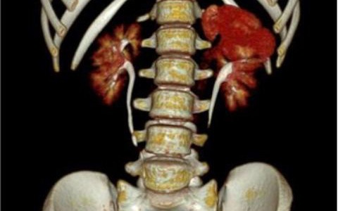 Phú Thọ: Bệnh nhi 10 tuổi có niệu quản cắm lạc chỗ hiếm gặp