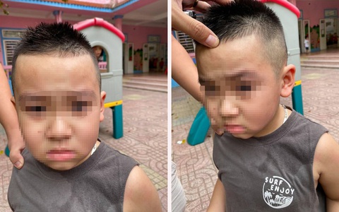 Vụ việc gây bức xúc: Con đi học mẫu giáo bị bạn cấu xước mí mắt, phụ huynh đến tận trường tát thẳng mặt trẻ trước mặt cô giáo