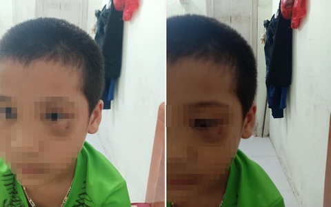 Vụ phụ huynh tát trẻ mẫu giáo: Người mẹ chính thức xin lỗi, công khai luôn ảnh đôi mắt bầm tím của con mình