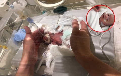 Chào đời nặng 268gr, bé trai sinh non nhỏ nhất thế giới "lột xác" ngoạn mục, nhìn ảnh ngày cậu bé ra viện ai cũng bất ngờ