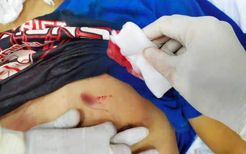 TP.HCM: Người đàn ông bị bạn gái đâm thủng tim phổi nguy kịch được cứu sống