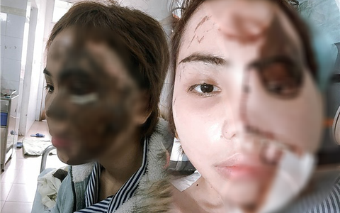 Cô gái Đà Nẵng bị chồng sắp cưới tạt axit gây rúng động: Ghép da lưng vào vùng mặt bị hủy hoại, đồng màu với da thật 80%