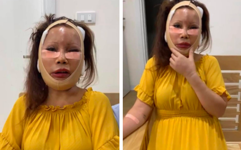 Vừa hoàn tất ca phẫu thuật thẩm mỹ không lâu, cô dâu 62 tuổi nay lại nắm tay chồng xuất hiện với gương mặt sưng phồng, băng bó khắp mặt 