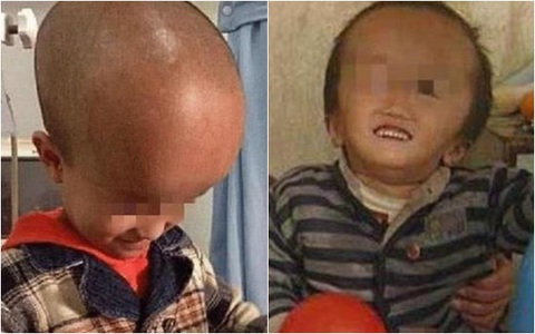 Sau 12 năm, những đứa trẻ uống sữa công thức nhiễm độc bây giờ thế nào?