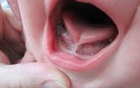 Trẻ chậm nói, khó phát âm, nói ngọng, chỉ nói được vài từ đơn giản: Nguyên nhân có thể do mắc dị tật này