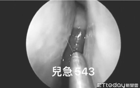 Bé trai 12 tuổi bị nghẹt mũi, chảy máu mũi suốt 1 tuần, đến bệnh viện khám bác sĩ gắp ra con đỉa dài 5cm to gấp 4 lần bình thường